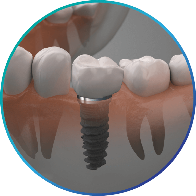 Single & Multiple Dental Implants 