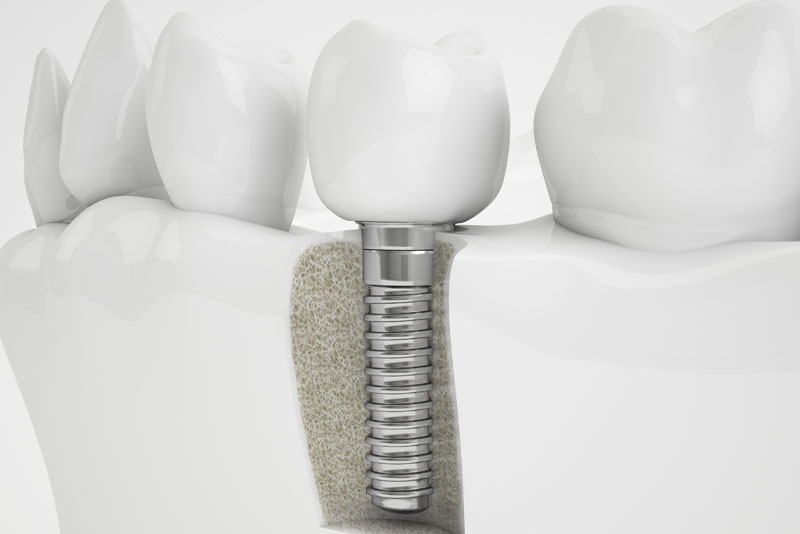 bone graft graphic