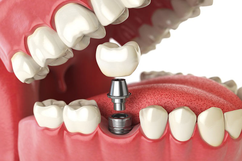 Should I Get Dentures Or Full Mouth Dental Implants In Flower Mound, TX