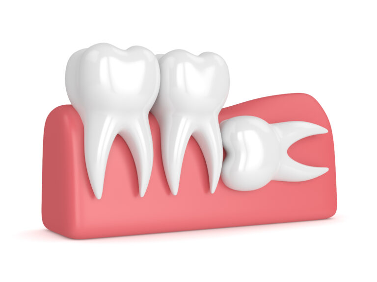3d render of teeth with wisdom horizontal impaction over white background. Concept of different types of wisdom teeth impactions.