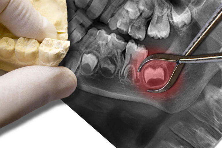 an image of an impacted wisdom tooth.