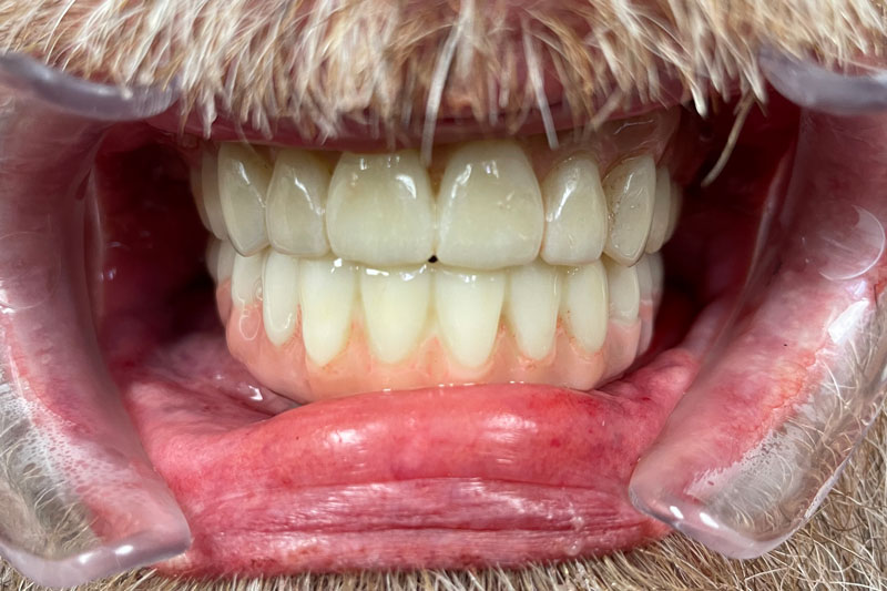 a full arch of teeth with implants from a patient that had severe oral issues