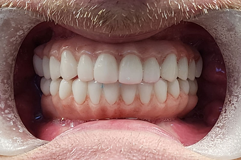 a patient after receiving both top and bottom full arches