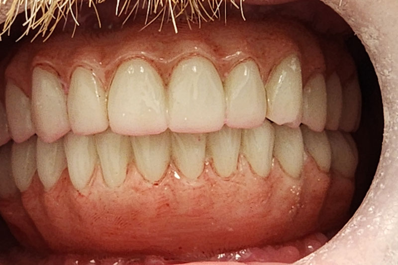 a patient with 2 full arches of teeth on top and bottom