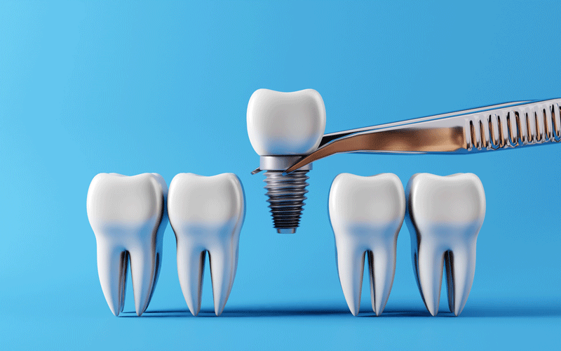 Dental teeth implants and Healthy white teeths. Oral health and dental inspection teeth.