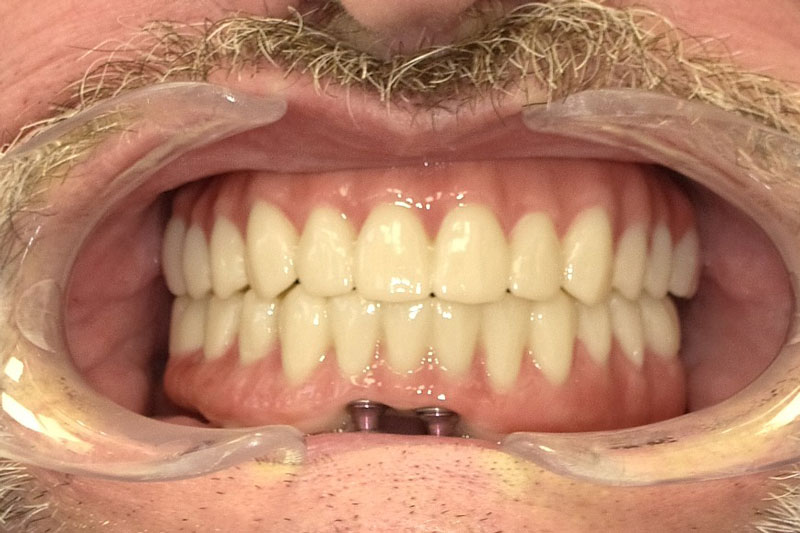 a patient with a full arch of teeth