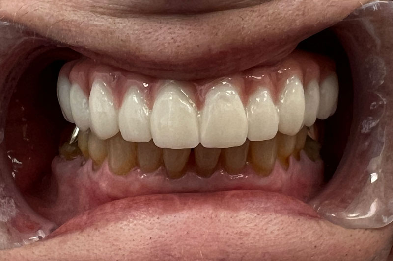 a patient that got a full upper arch of teeth