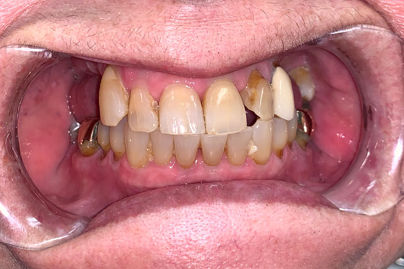 a patient with crowns and severe plaque issues