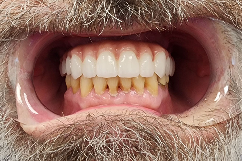 a patient with a full arch of teeth on top to repair his smile