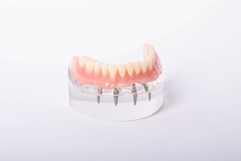 All-on-4 implant-supported denture model on a white background, showing screws and full lower arch fixed to a clear acrylic base.