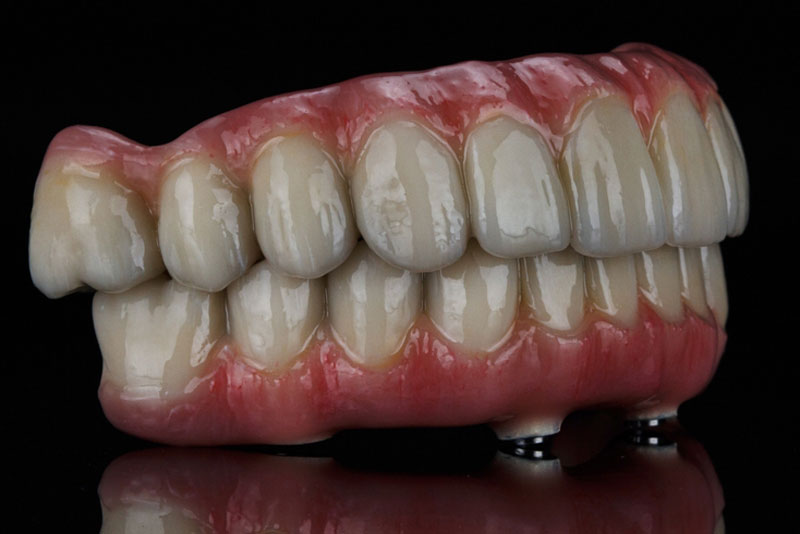 A detailed image of a full-mouth dental implant prosthesis featuring realistic upper and lower arches with lifelike ceramic teeth and pink gum base, shown on a black background. A detailed image of a full-mouth dental implant prosthesis featuring realistic upper and lower arches with lifelike ceramic teeth and pink gum base, shown on a black background.
