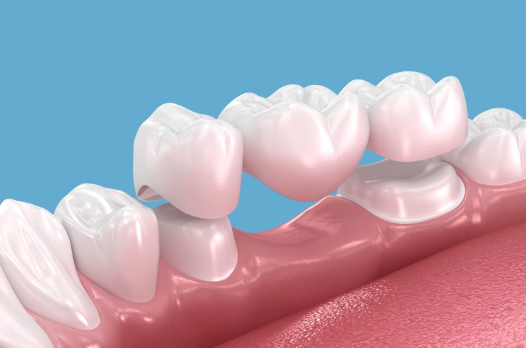 3D illustration of a dental bridge spanning a missing tooth, showing how the restoration connects to surrounding teeth, one option patients consider when replacing a missing tooth.