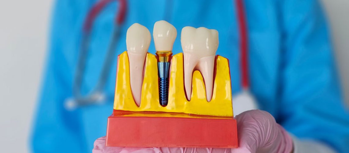 Dentist demonstrates dental implants and crown models in a clinical setting during consultation.