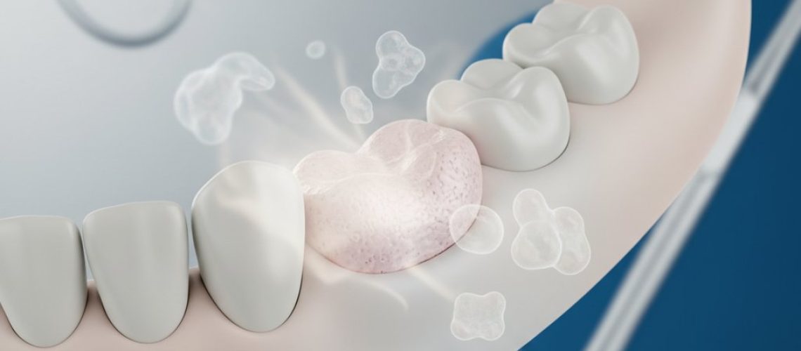 Stylized close-up of a jawbone section showing a bone graft integration with subtle color gradients and a soft, ethereal glow.