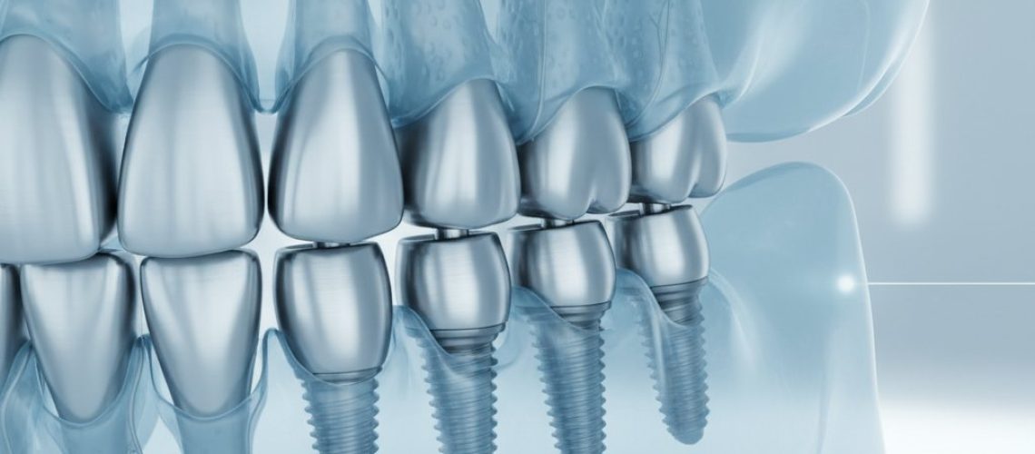 Digital 3D model of a semi-transparent jawbone with titanium dental implants. Cool blues, whites, and grays.