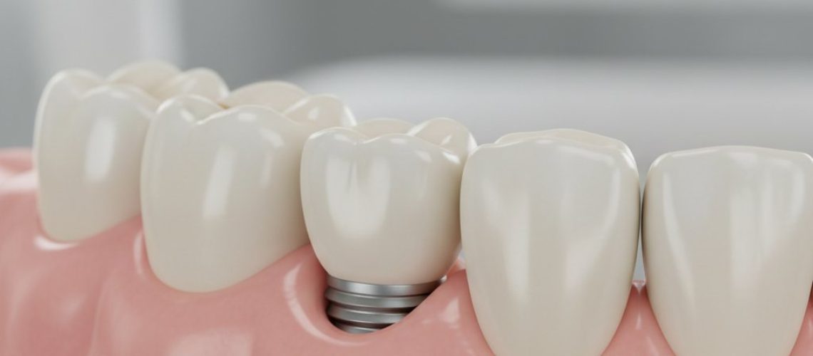 Close-up of a dental implant seamlessly integrated with healthy gums and teeth, showcasing natural aesthetics.