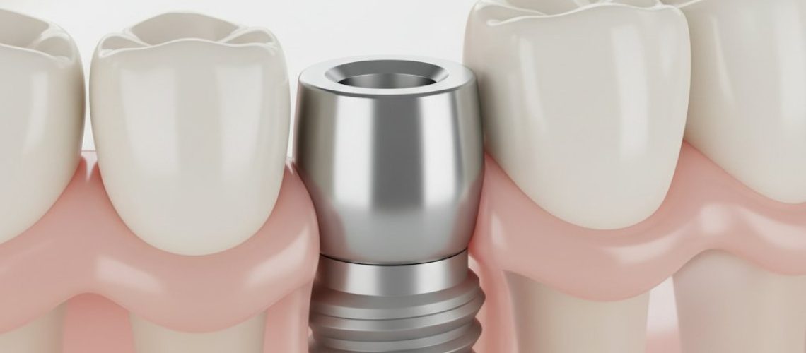 Dental implant seamlessly integrated into healthy jawbone. Titanium post, pink gums, soft lighting, blurred background.