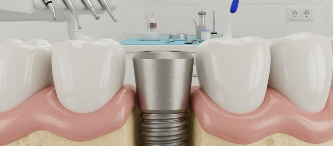 Close-up of dental implant integrated with bone and healthy gums. Soft lighting, blurred dental office background.