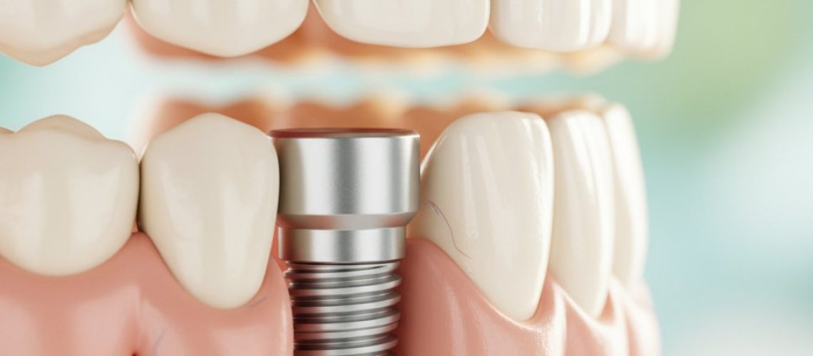 Dental implant close-up. Titanium implant seamlessly integrates with healthy jawbone. Warm light, soft sterile background.
