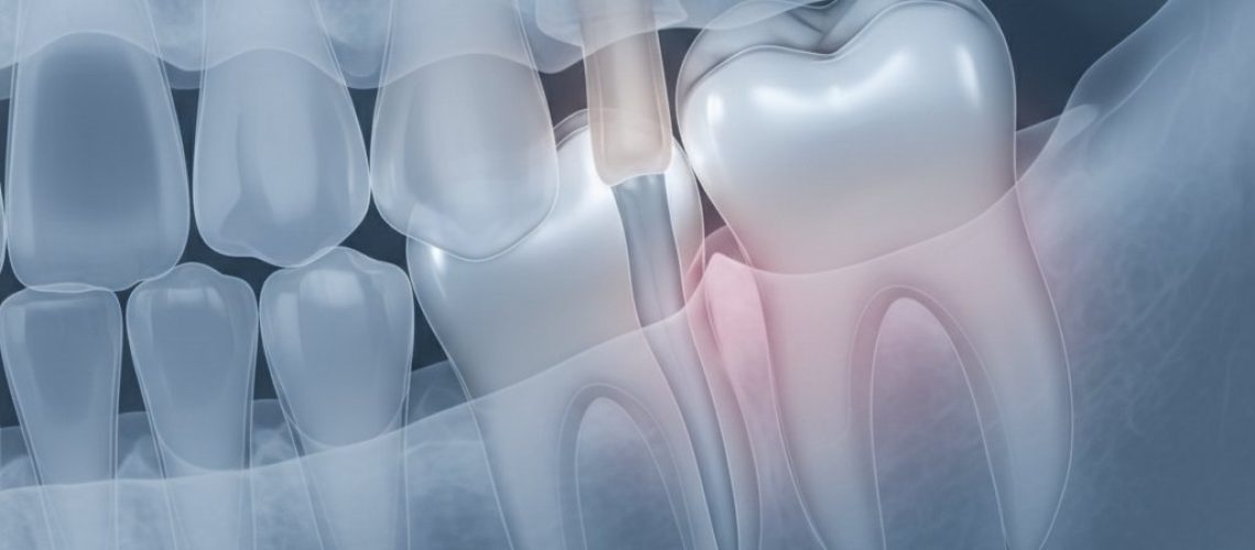 Stylized dental x-ray of lower jaw shows impacted wisdom teeth pressing against molar roots. Muted blues, greys, pink hints. Sharp focus.