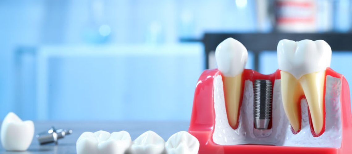 2024-05-implant-model-resting-on-table