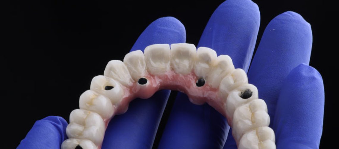 2024-08-Imp3-Photo-dental-implant-work-is-completed-and-ready-to-use-dental-implant-temporary-abutment