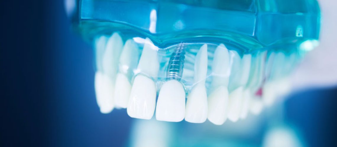 2024-08-Imp4-Dental-tooth-implant-titanium-prosthetic-dentists-model