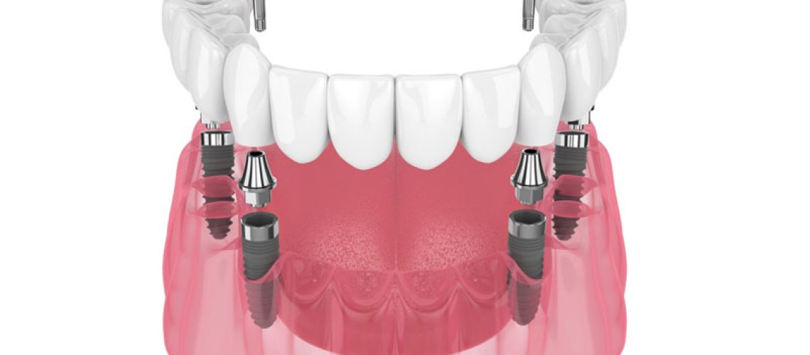 3D illustration of a full upper dental arch implant system, full set of upper teeth being attached. set against a white background