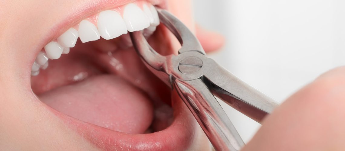 an image of a tooth extraction.