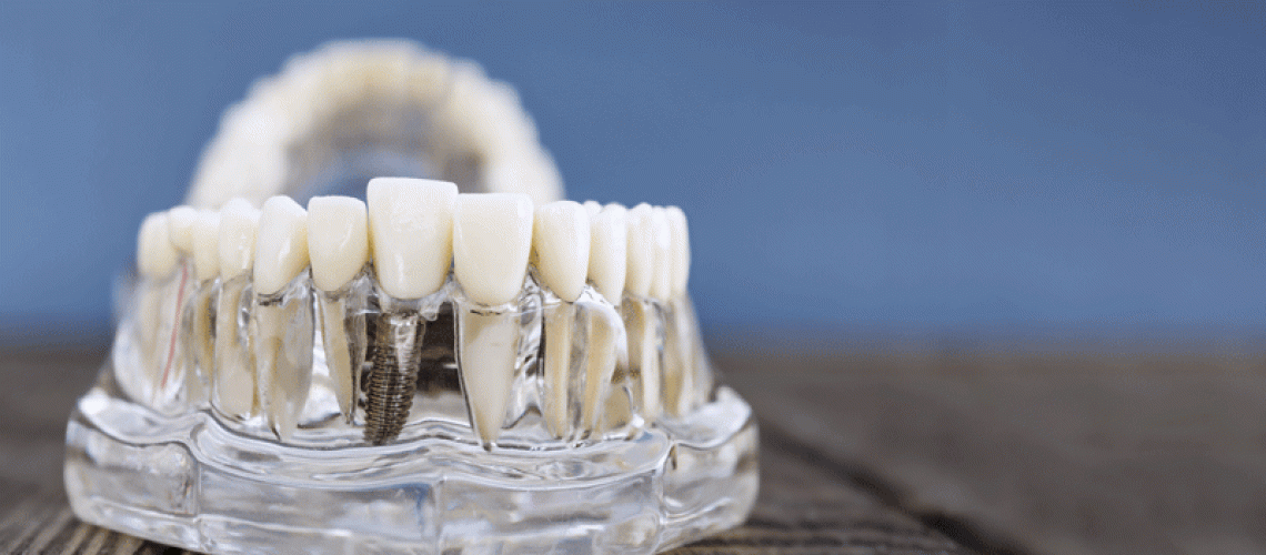 Dental Implant Model Showcasing Prosthetic Teeth on a Transparent Jaw for Educational