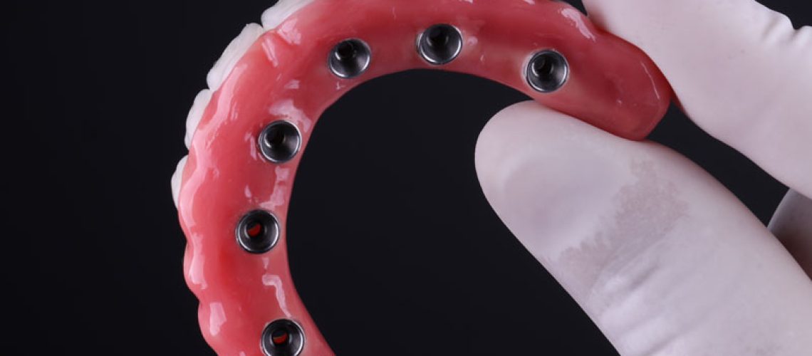 Dental Implants Prosthetic Porcelain Rehabilitation, dentist is holding the model in a dark room with black gloves