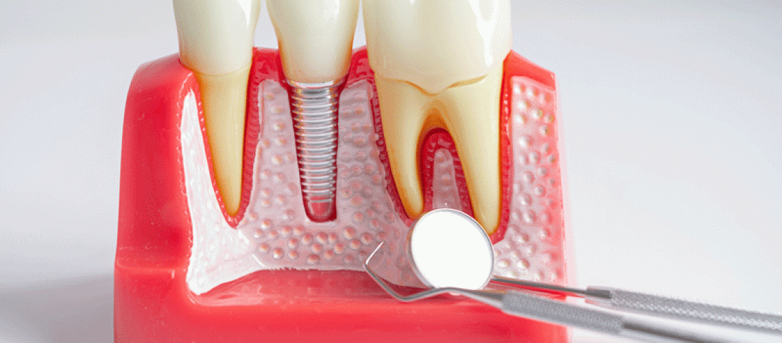 Dental implant, artificial tooth roots into jaw, root canal of dental treatment, gum disease, teeth model for dentist studying about dentistry.