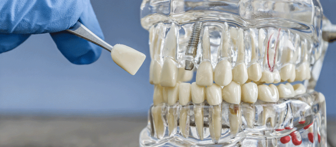 Dental Implant Model Showcasing Prosthetic Teeth on a Transparent Jaw for Educational