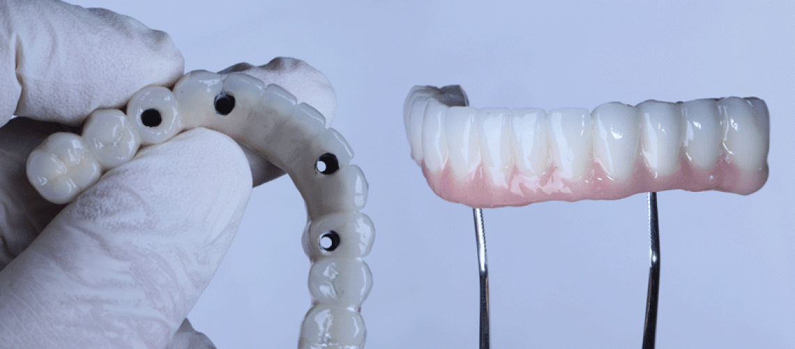 Full arch porcelain dental prosthesis on only 4 implants for completely edentulous jaws in dental jaw surgery and dentistry