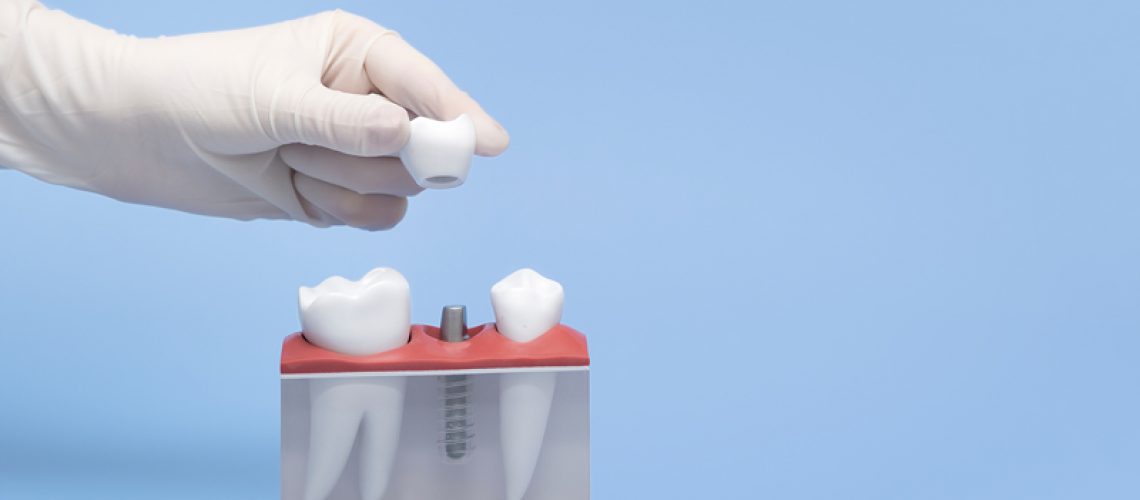 A hand in a white glove holds a model of a tooth implant blue table and background