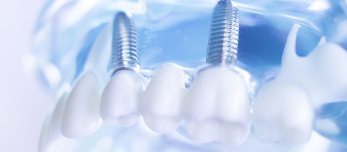 IMP1-Dentists-dental-prosthetic-teeth-gums-roots-teaching-student-model-with-titanium-metal-screw-implant