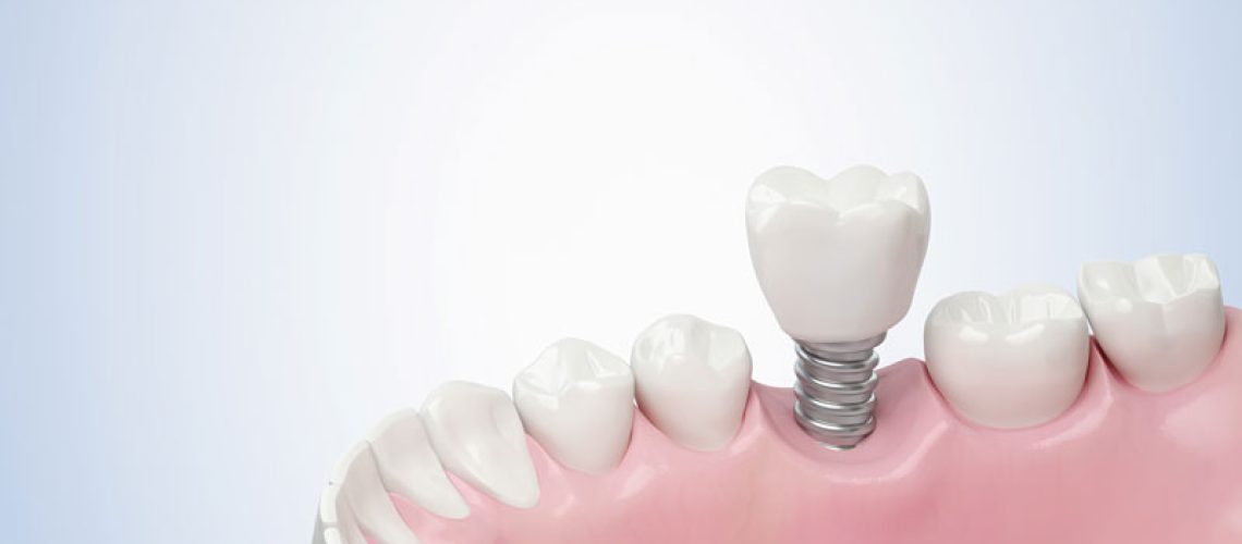 IMP2-Closeup-white-tooth-and-gum-with-Dental-implant-Human-Teeth-for-Medical-Concept-1