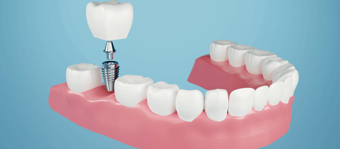 IMP2-Dental-implant-Fix-missing-teeth-with-metal-screw-teeth-crown-treatment-3D-rendering