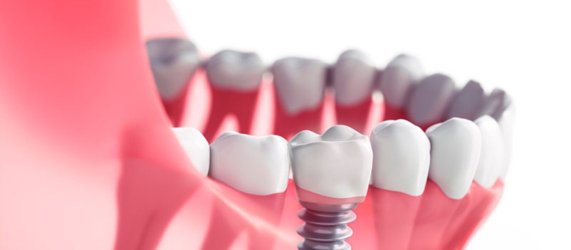 IMP3-Closeup-of-dental-implant