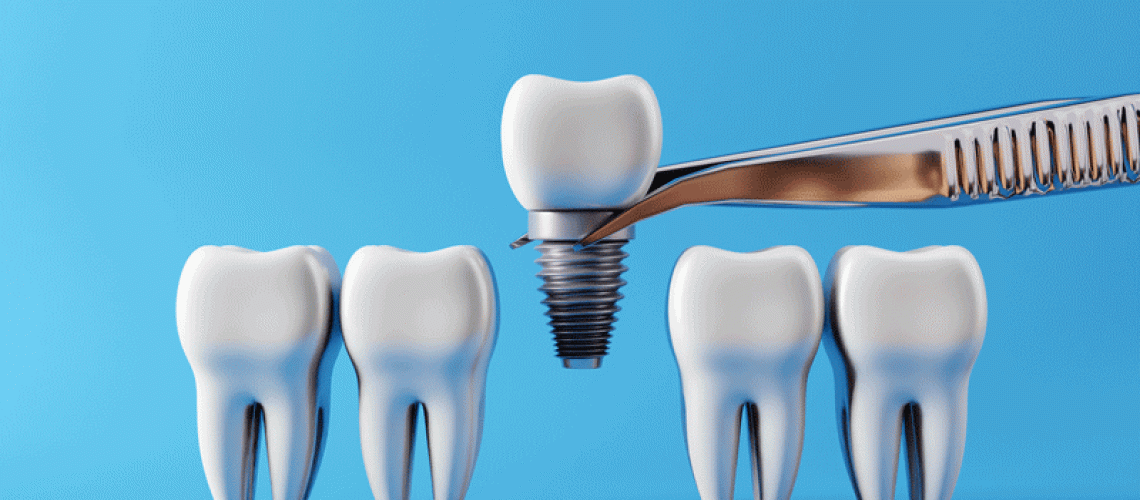 IMP3-Dental-teeth-implants-and-Healthy-white-tooths.-Oral-health-and-dental-inspection-teeth