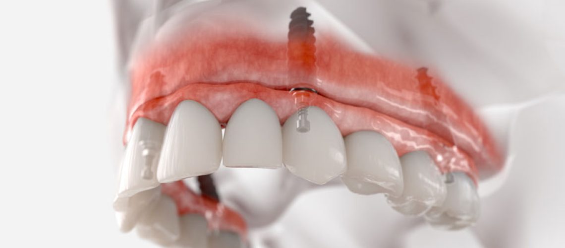 IMP4-Maxillary-fixed-restoration-with-4-implants