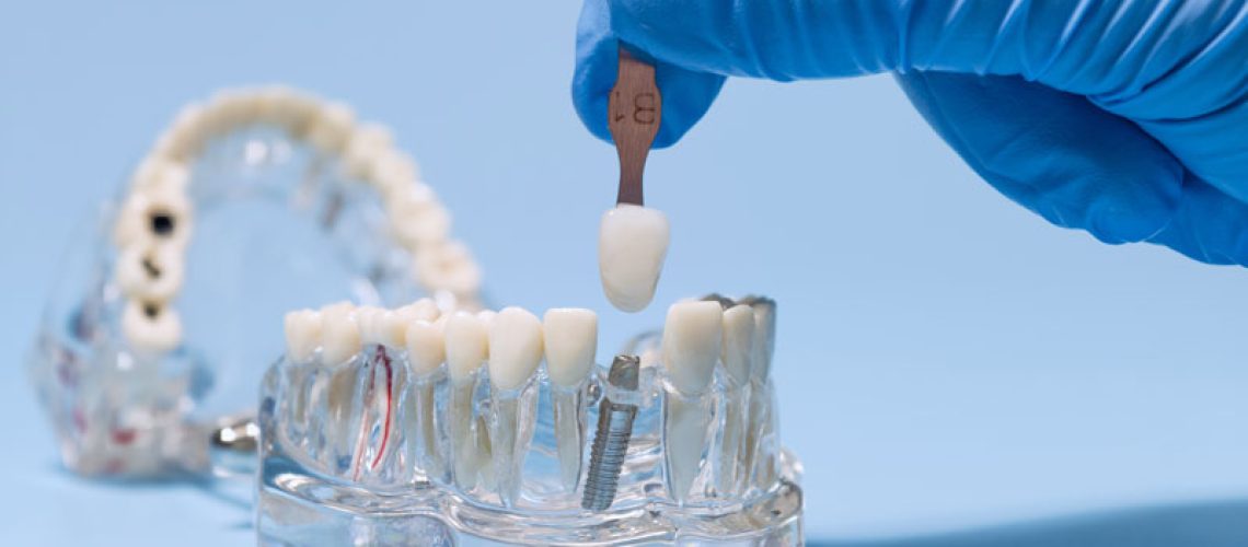 Dental implant color matching with shade guide, blue background dental office, dentist has blue gloves