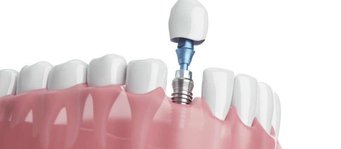 a digital model of a lower arch receiving a single dental implant.