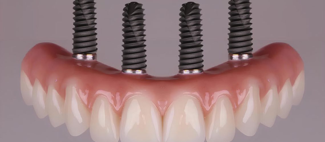 all-4-dental-implants