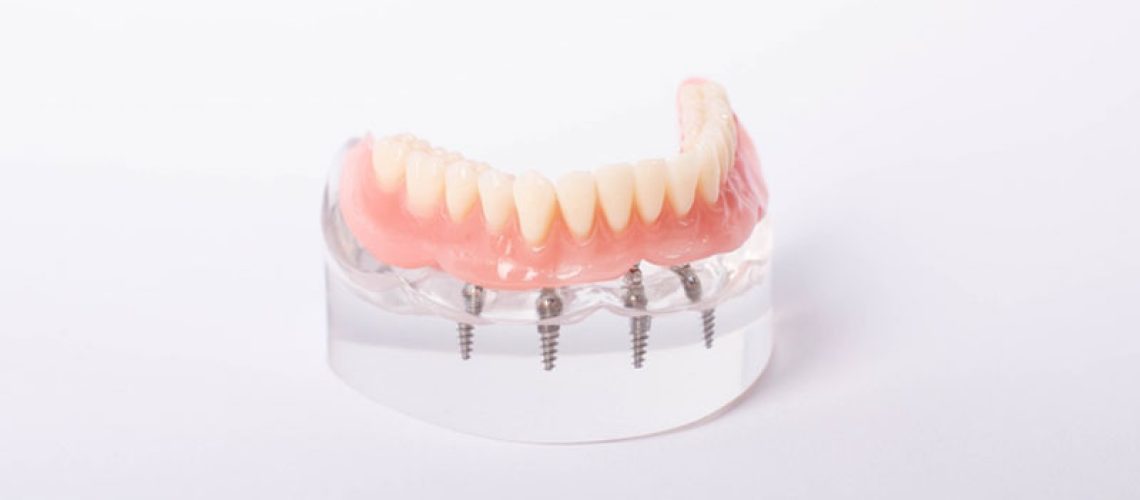 All-on-4 implant-supported denture model on a white background, showing screws and full lower arch fixed to a clear acrylic base.
