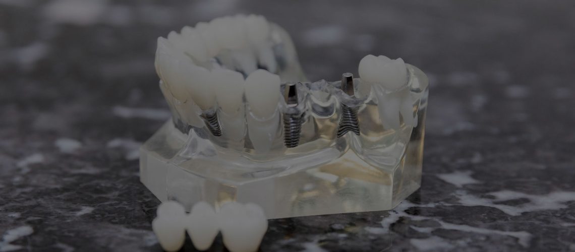 dental implant model