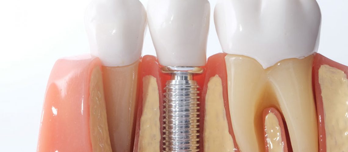 a dental implant model bone cutaway showing the dental implant post.