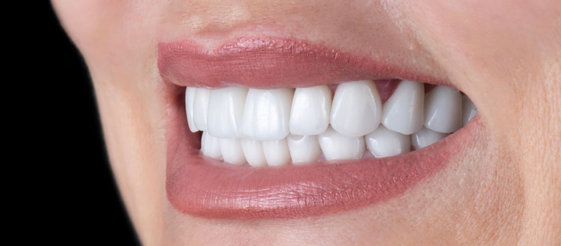 dental-implants-1