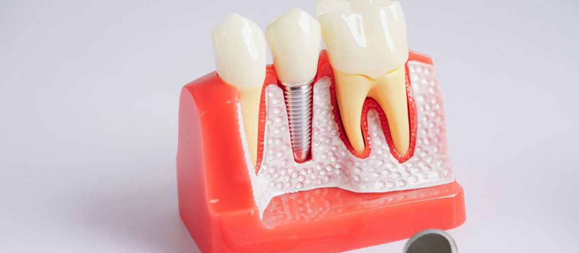 dental-implants-3