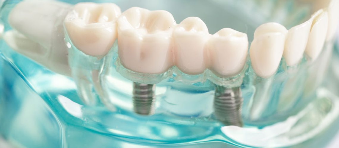 dental-implants-4